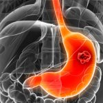 imagen del artículo: 15 visitas y el cáncer sin detectar